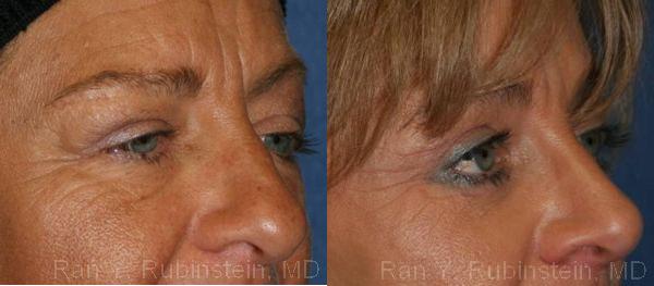 Brow Lift Before and After Photos in Montvale, NJ, Patient 12522
