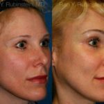 Brow Lift Before and After Photos in Montvale, NJ, Patient 12525