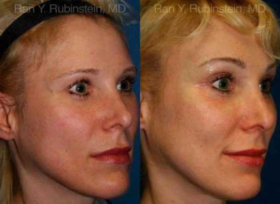 Brow Lift Before and After Photos in Montvale, NJ, Patient 12525