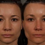 Ethnic Rhinoplasty Before and After Photos in Montvale, NJ, Patient 12528