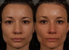 Ethnic Rhinoplasty Before and After Photos in Montvale, NJ, Patient 12528