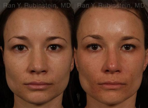 Ethnic Rhinoplasty Before and After Photos in Montvale, NJ, Patient 12528