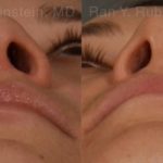 Ethnic Rhinoplasty Before and After Photos in Montvale, NJ, Patient 12528