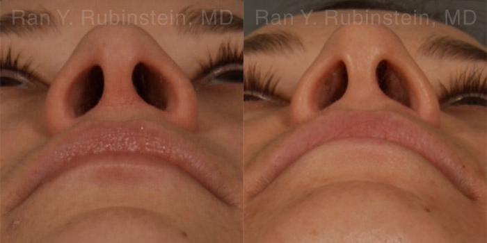 Ethnic Rhinoplasty Before and After Photos in Montvale, NJ, Patient 12528