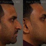 Ethnic Rhinoplasty Before and After Photos in Montvale, NJ, Patient 12538