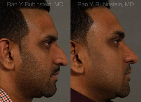 Ethnic Rhinoplasty Before and After Photos in Montvale, NJ, Patient 12538