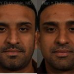 Ethnic Rhinoplasty Before and After Photos in Montvale, NJ, Patient 12538