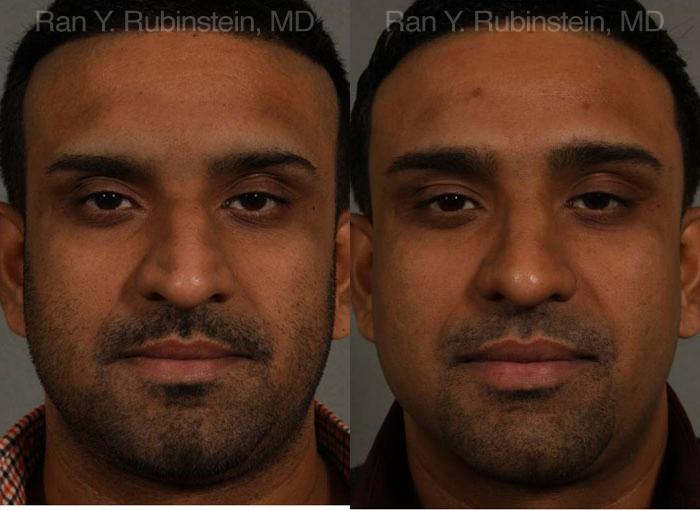 Ethnic Rhinoplasty Before and After Photos in Montvale, NJ, Patient 12538