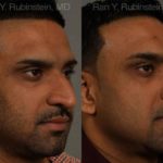 Ethnic Rhinoplasty Before and After Photos in Montvale, NJ, Patient 12538