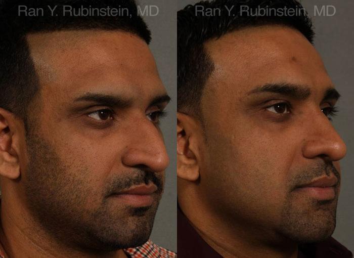 Ethnic Rhinoplasty Before and After Photos in Montvale, NJ, Patient 12538