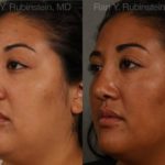 Ethnic Rhinoplasty Before and After Photos in Montvale, NJ, Patient 12545