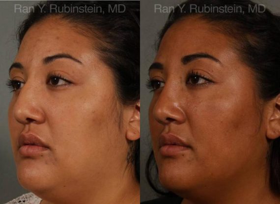Ethnic Rhinoplasty Before and After Photos in Montvale, NJ, Patient 12545