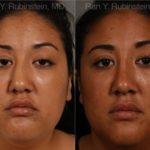 Ethnic Rhinoplasty Before and After Photos in Montvale, NJ, Patient 12545