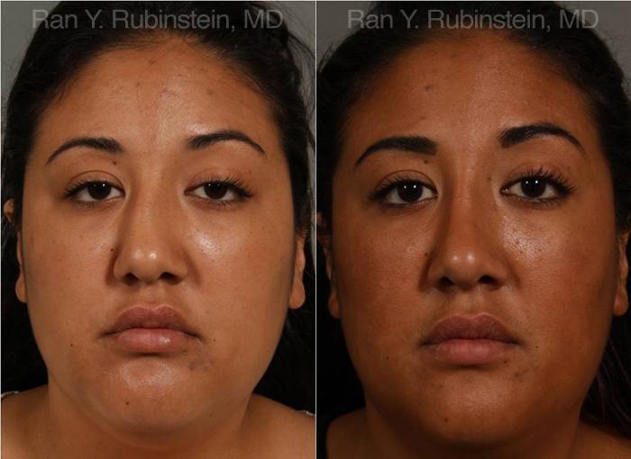 Ethnic Rhinoplasty Before and After Photos in Montvale, NJ, Patient 12545