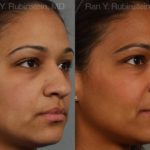 Ethnic Rhinoplasty Before and After Photos in Montvale, NJ, Patient 12550