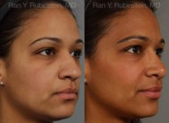 Ethnic Rhinoplasty Before and After Photos in Montvale, NJ, Patient 12550