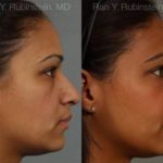 Ethnic Rhinoplasty Before and After Photos in Montvale, NJ, Patient 12550