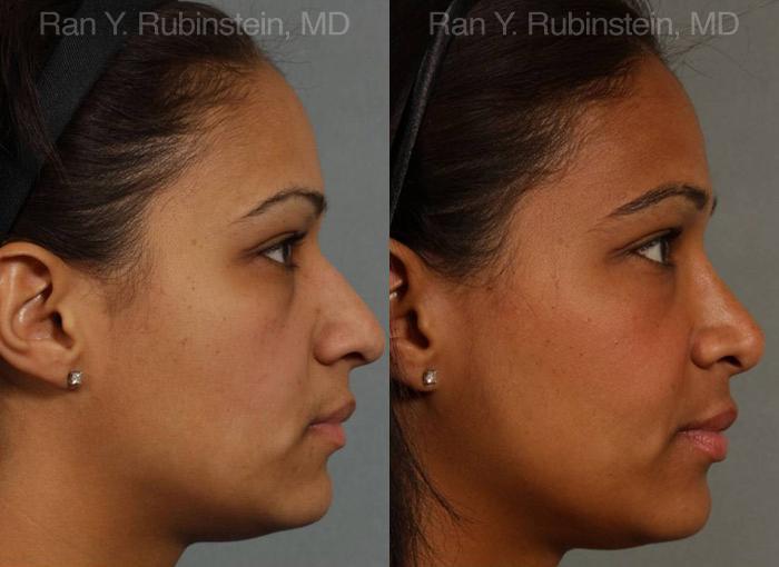 Ethnic Rhinoplasty Before and After Photos in Montvale, NJ, Patient 12550