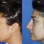 Ethnic Rhinoplasty Before and After Photos in Montvale, NJ, Patient 12555