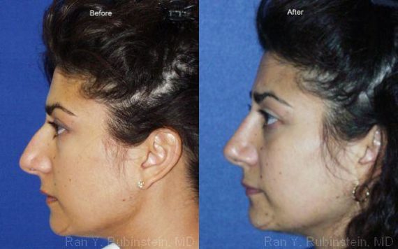 Ethnic Rhinoplasty Before and After Photos in Montvale, NJ, Patient 12555