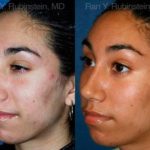 Ethnic Rhinoplasty Before and After Photos in Montvale, NJ, Patient 12568