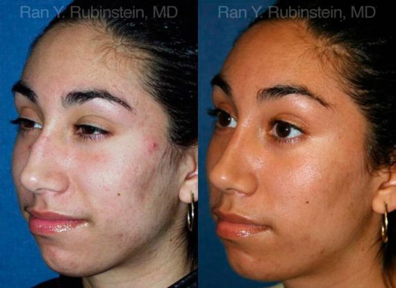 Ethnic Rhinoplasty Before and After Photos in Montvale, NJ, Patient 12568