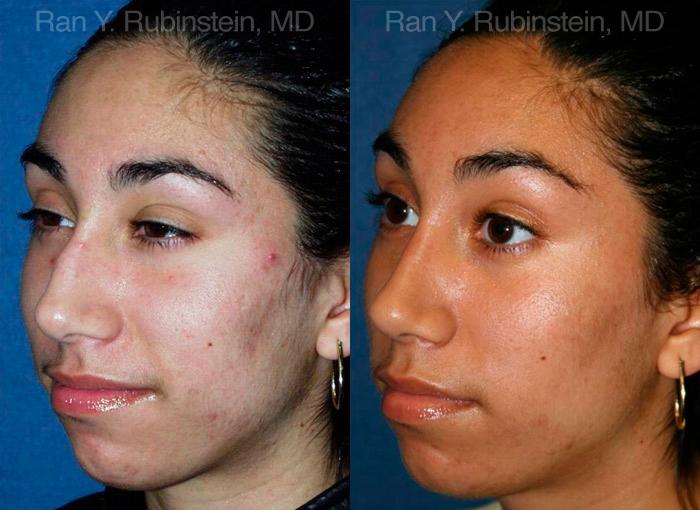 Ethnic Rhinoplasty Before and After Photos in Montvale, NJ, Patient 12568