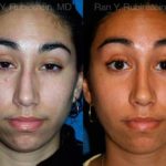 Ethnic Rhinoplasty Before and After Photos in Montvale, NJ, Patient 12568