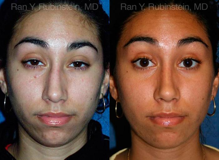 Ethnic Rhinoplasty Before and After Photos in Montvale, NJ, Patient 12568