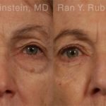 Eyelid Surgery Before and After Photos in Montvale, NJ, Patient 12583