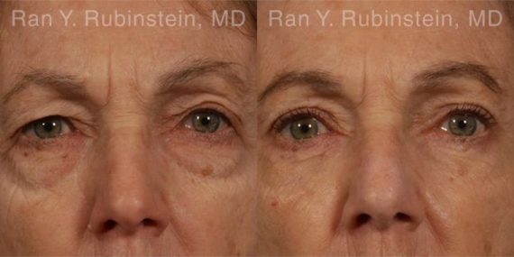 Eyelid Surgery Before and After Photos in Montvale, NJ, Patient 12583