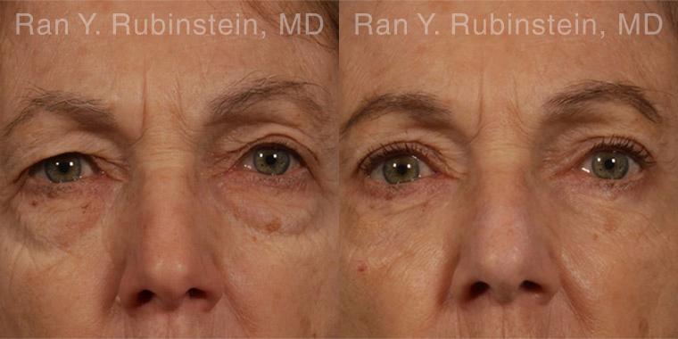 Eyelid Surgery Before and After Photos in Montvale, NJ, Patient 12583