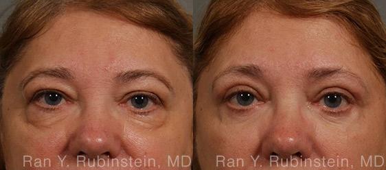 Eyelid Surgery Before and After Photos in Montvale, NJ, Patient 12596