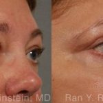 Eyelid Surgery Before and After Photos in Montvale, NJ, Patient 12596