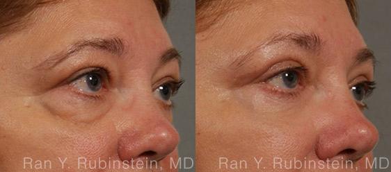 Eyelid Surgery Before and After Photos in Montvale, NJ, Patient 12596