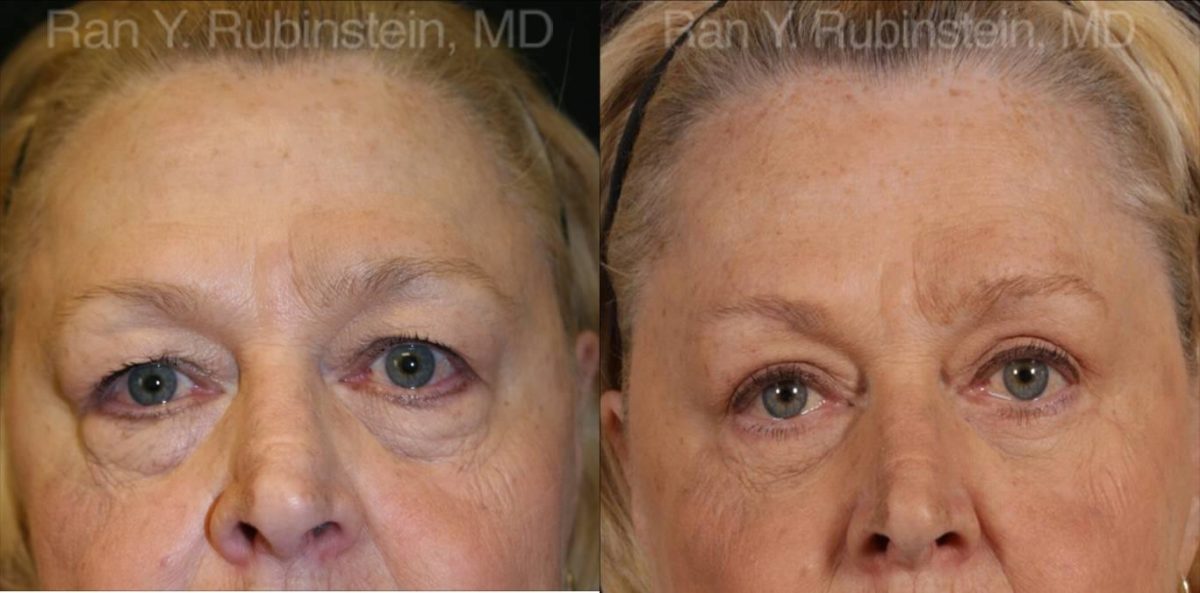 Eyelid Surgery Before and After Photos in Montvale, NJ, Patient 12601
