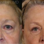 Eyelid Surgery Before and After Photos in Montvale, NJ, Patient 12601