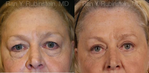 Eyelid Surgery Before and After Photos in Montvale, NJ, Patient 12601
