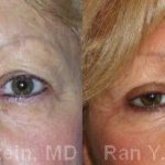 Eyelid Surgery Before and After Photos in Montvale, NJ, Patient 12604
