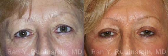 Eyelid Surgery Before and After Photos in Montvale, NJ, Patient 12604