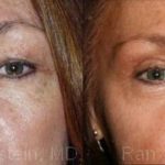 Eyelid Surgery Before and After Photos in Montvale, NJ, Patient 12607