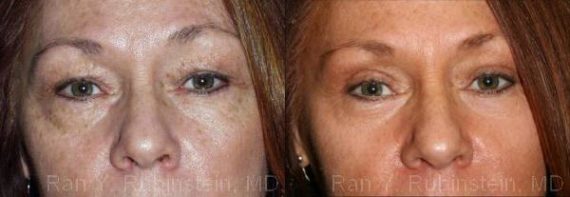 Eyelid Surgery Before and After Photos in Montvale, NJ, Patient 12607