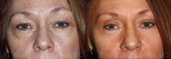 Eyelid Surgery Before and After Photos in Montvale, NJ, Patient 12607
