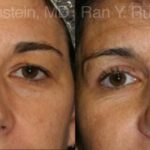 Eyelid Surgery Before and After Photos in Montvale, NJ, Patient 12613
