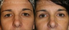 Eyelid Surgery Before and After Photos in Montvale, NJ, Patient 12613
