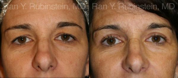 Eyelid Surgery Before and After Photos in Montvale, NJ, Patient 12613