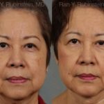 Face lift & Neck lift Before and After Photos in Montvale, NJ, Patient 12641