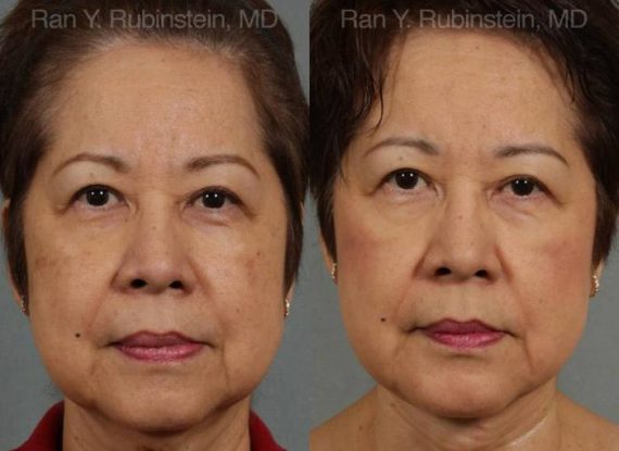 Face lift & Neck lift Before and After Photos in Montvale, NJ, Patient 12641