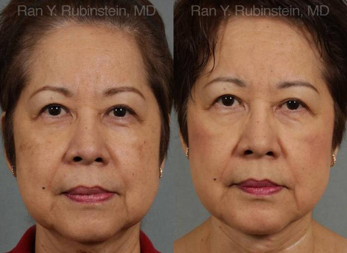 Face lift & Neck lift Before and After Photos in Montvale, NJ, Patient 12641