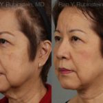 Face lift & Neck lift Before and After Photos in Montvale, NJ, Patient 12641